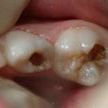 Лечение кариеса у детей (лечение молочных зубов)
