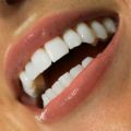 Эстетическая реставрация боковых зубов