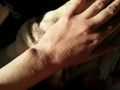 Атопический дерматит лечение. Иридодиагностика и китайская медицина