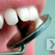 Диотермокоагуляция десны в области одного зуба