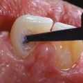 Внутриканальное отбеливание зуба