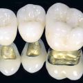 Металлокерамическая коронка в «Ладент» – лучшее решение для восстановления разрушенного зуба!