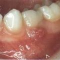 Лечение периодонтита молочного зуба
