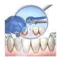Снятие зубных отложений при помощи пескоструйного аппарата Air Flow и покрытие фторсодержащим лаком