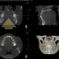 Трехмерное рентгенологическое исследование (компьютерная, конусно-лучевая томография или просто КТ) 12*8,5 см