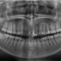 Панорамная рентгенограмма зубных рядов