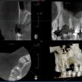 Трехмерное рентгенологическое исследование (компьютерная, конусно-лучевая томография или просто КТ) КТ 5*5 см