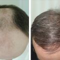 Клиника Пересадки Волос (Центра Здоровья Волос)