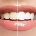 Белее белого: профессиональная чистка зубов для ослепительной улыбки