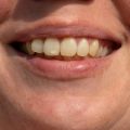 Точки и пятна на зубах: почему появляются и что с ними делать?