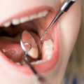 Детская стоматология, Лечение пульпита молочного зуба
