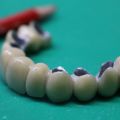 Ортопедическая стомотология. Изготовление металлокерамической коронки (жевательная группа зубов)