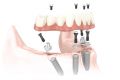 Протезирование зубов на 4 имплантах, преимущества в клинике Ладент