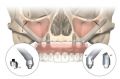 Виды протезирования зубов в стоматологии Ладент